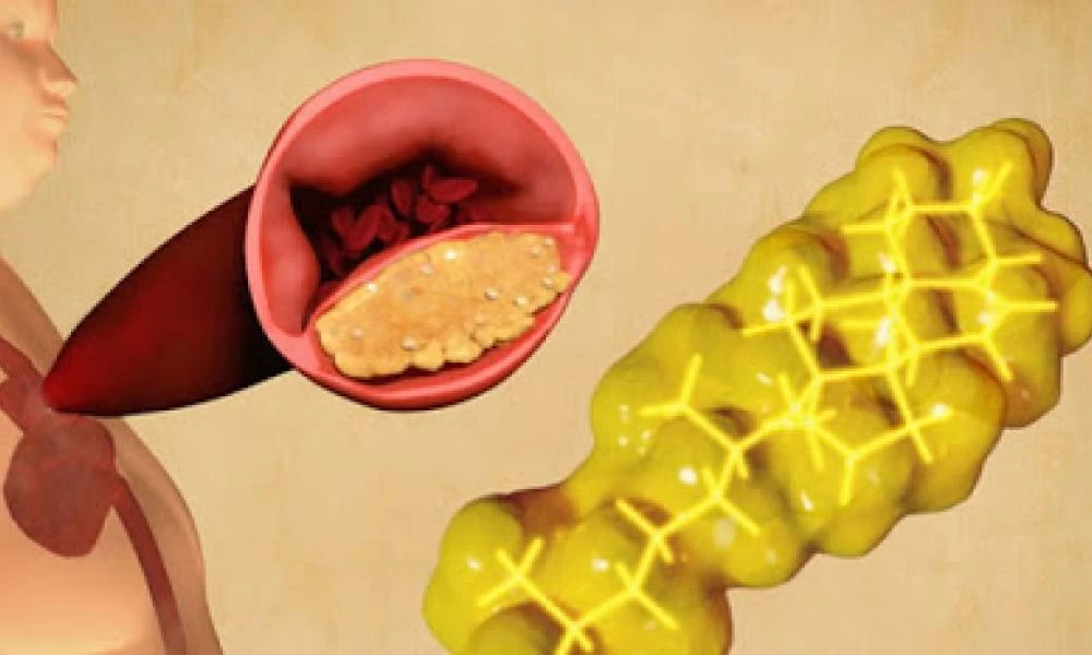 Τριγλυκερίδια: Υπάρχει τρόπος να «καθαρίσουμε» το αίμα